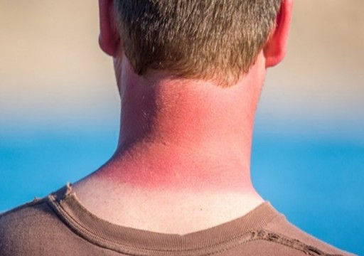 9 نصائح لحماية بشرتك من أشعة الشمس الضارة