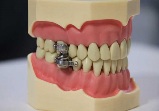 "قفل الأسنان".. علماء يطورون جهازا يمنع الأكل للقضاء على السمنة