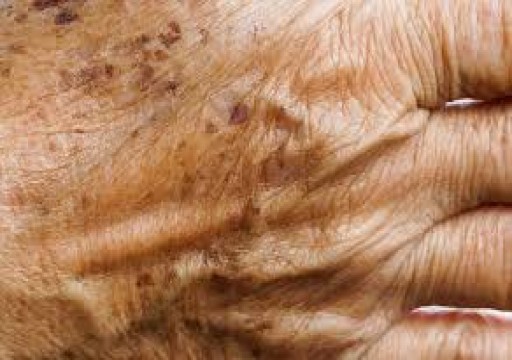 دراسة تكشف عن دواء تثبيط للمناعة يوقف شيخوخة الجلد