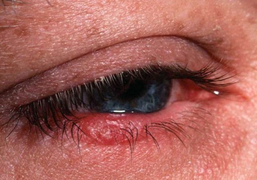 ما أعراض وأسباب جفاف العين؟