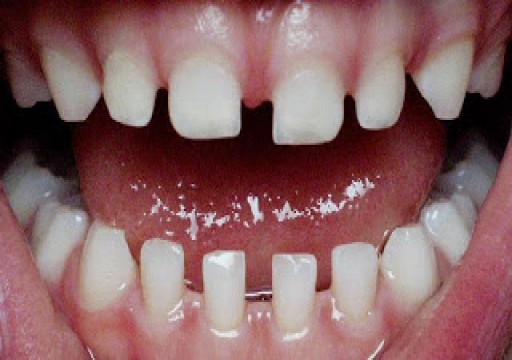 ما أسباب تواجد الفراغات بين الأسنان؟