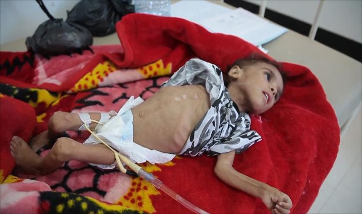 غارديان: الجوع والكوليرا يقتلان 80% من أطفال اليمن