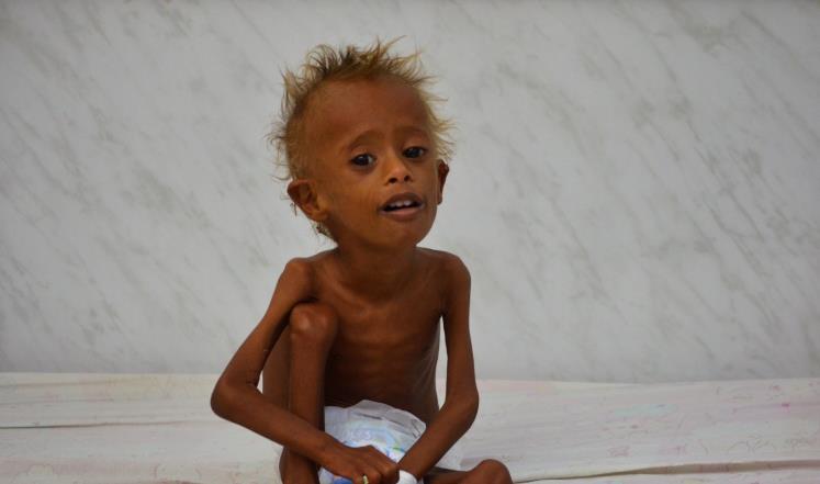 50 ألف طفل يمني معرضون للموت بنهاية العام